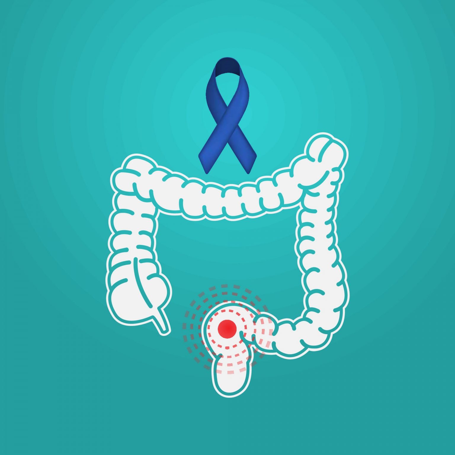 Colon Cancer: Knowing Your Risks and How to Cope